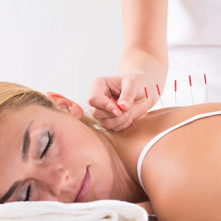 Chiropractic Erie CO Woman Receiving Acupuncture