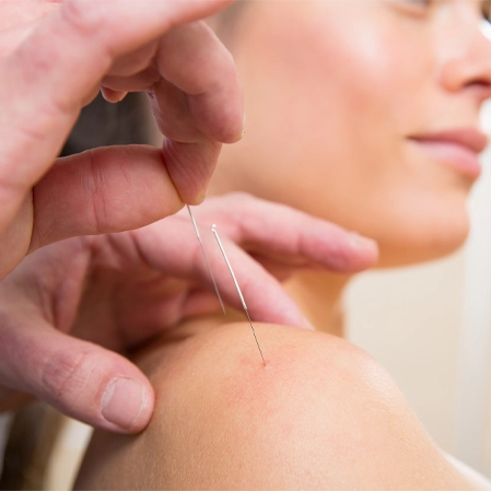 Chiropractic Erie CO Woman Receiving Dry Needling